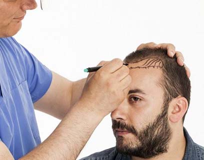 Saç Ekimi Tedavisi Nasıl Gerçekleştirilir