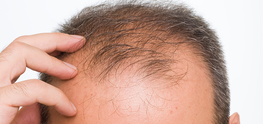 Saç Ekim Tedavisi Kaç Günde Uygulanmaktadır ?