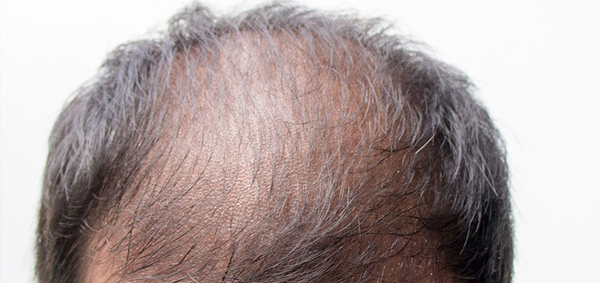 Erkeklerde Saç Dökülmesi Neden Olan Durumlar Nelerdir?